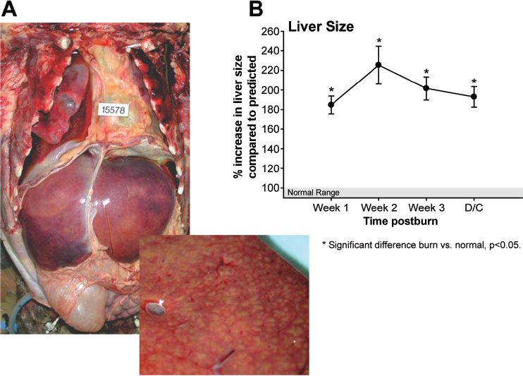 The Hepatic Response To Thermal Injury Is The Liver