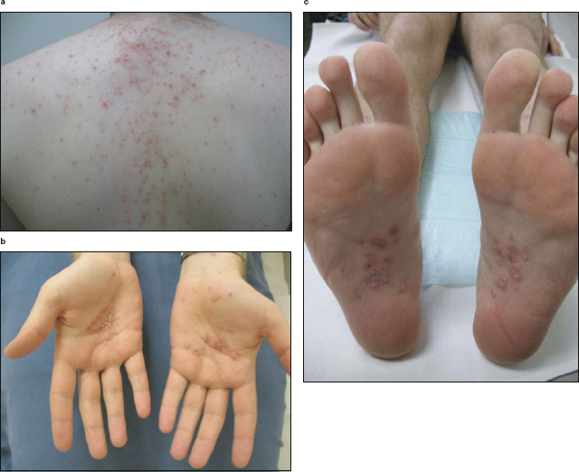 Tumor Necrosis Factor