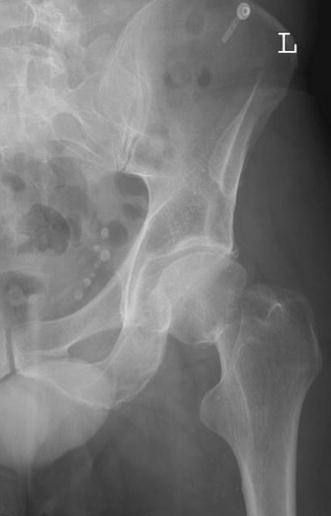 femoral neck fracture femoral neck fracture