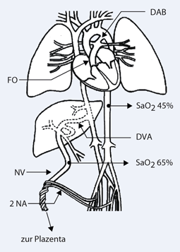 Reanimation des Neugeborenen | SpringerLink