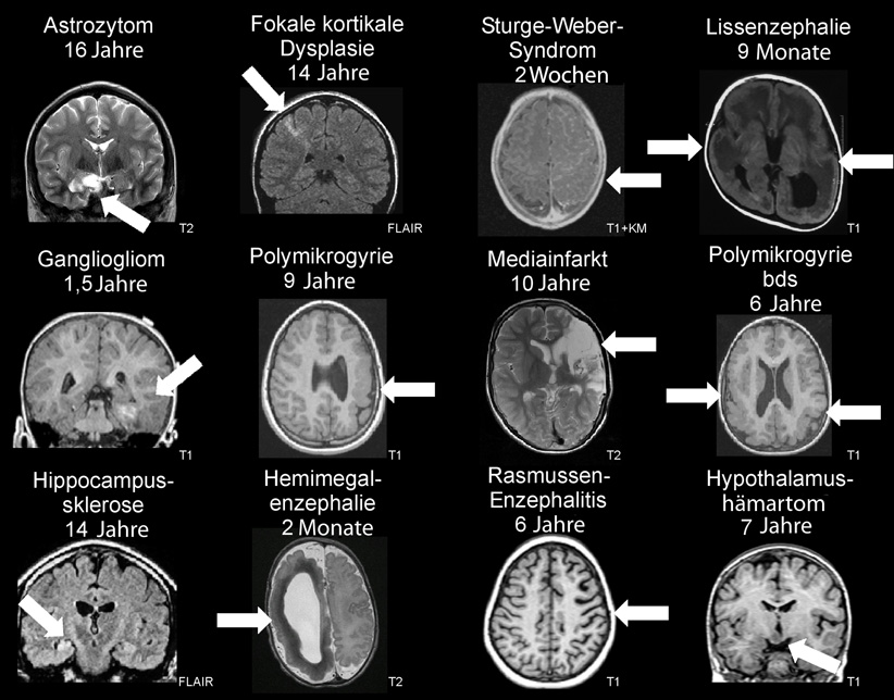 Diagnostik schwer behandelbarer Epilepsien bei Kindern und ...