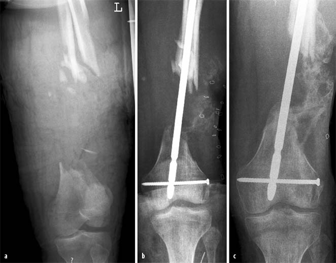 Der „Vacuumassisted closure and instillation“ (VAC™Instill)Verband