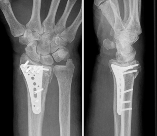Mulitdirektional winkelstabile volare Platte bei distaler Radiusfraktur