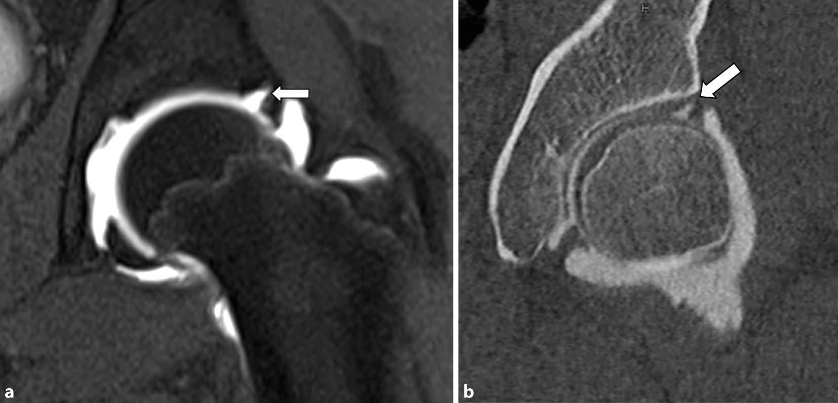 Labrumpathologie des Hüftgelenkes | SpringerLink