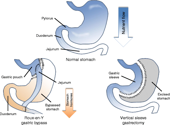 Mechanisms Underlying Weight Loss And Metabolic Improvements In Rodent ...