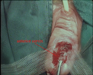 prolapse uterine anterior fig mesh laparoscopic extraperitoneal abdominal easier modified suspension treat way cervix