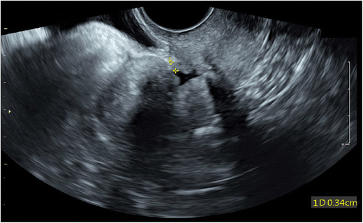 saline sonogram painful saline sonogram painful