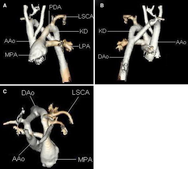 Right Aortic Arch with Anomalous Left Subclavian Artery and Left-Sided ...