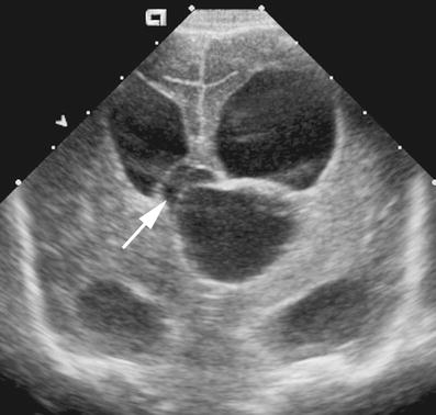 Sonographic findings in bacterial meningitis in neonates and young ...