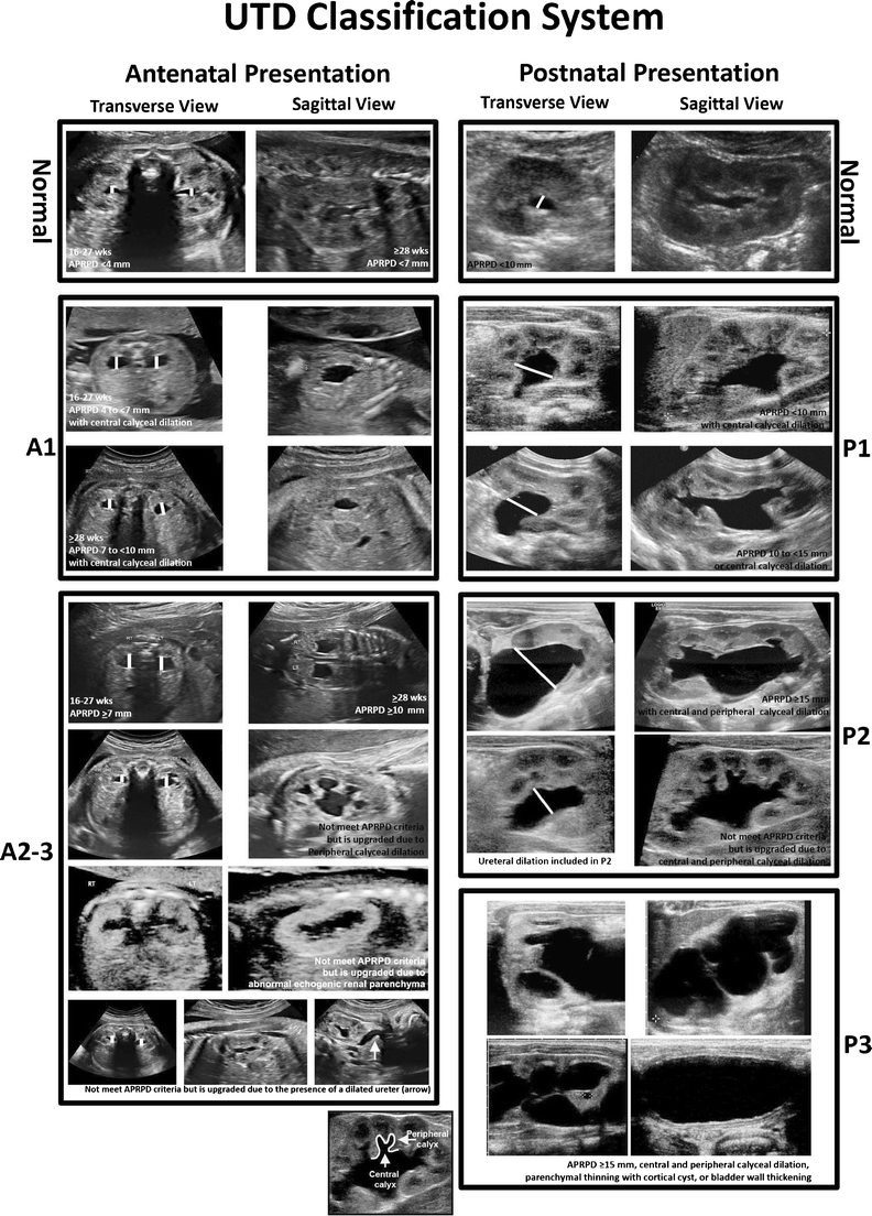 Multidisciplinary Consensus On The Classification Of Antenatal And Postnatal Urinary Tract