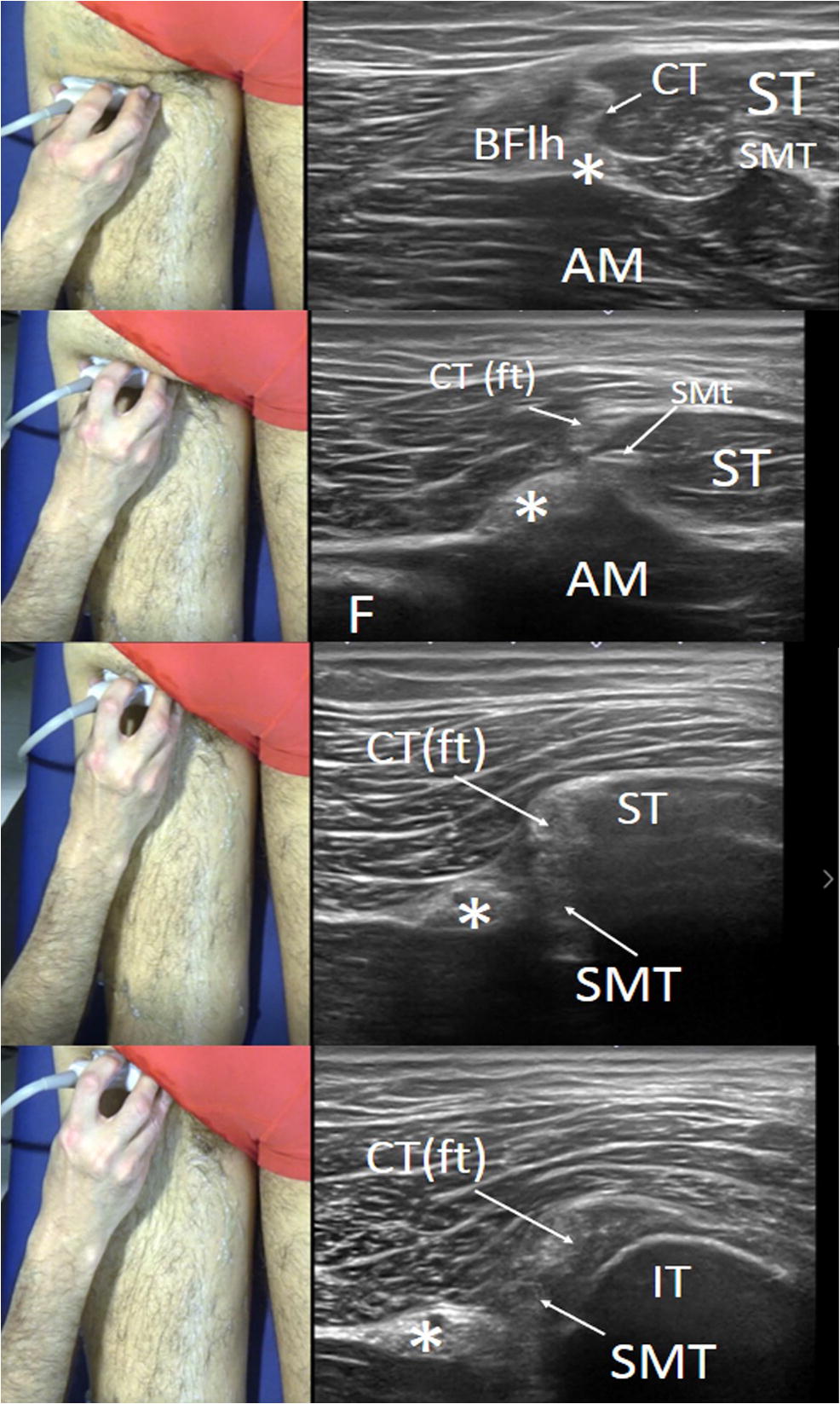 Sonographic landmarks in hamstring muscles | SpringerLink