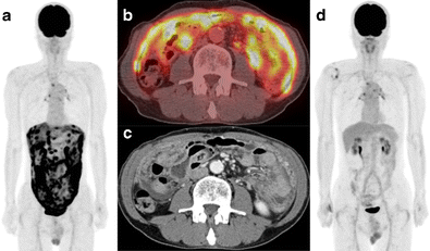 Treatment monitoring with 18F-FDG PET/CT in a patient with peritoneal ...
