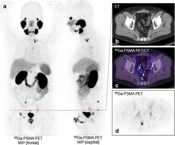 PSMA PET/CT with Glu-urea-Lys-(Ahx)-[68Ga(HBED-CC)] versus 3D CT ...