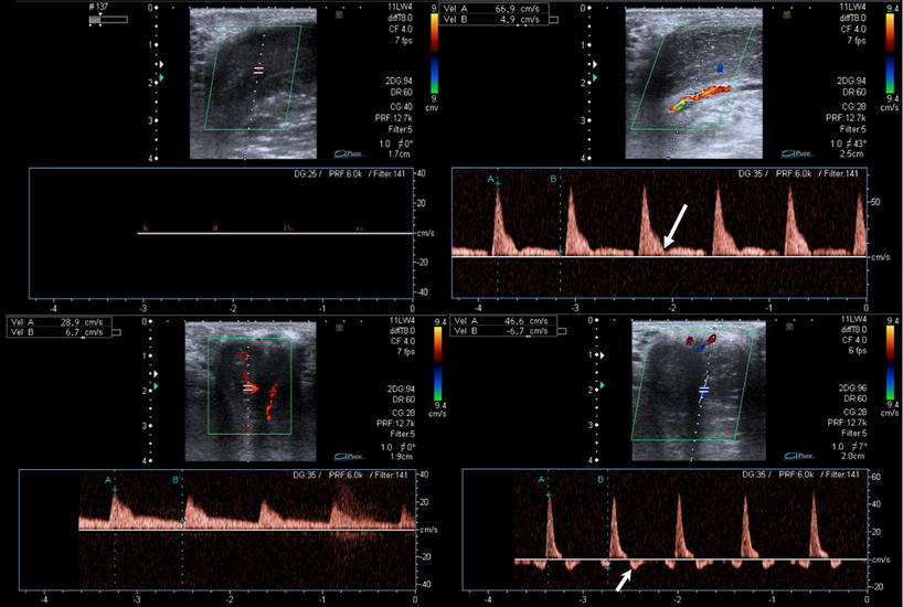 Erectile dysfunction: the role of penile Doppler ultrasound in ...