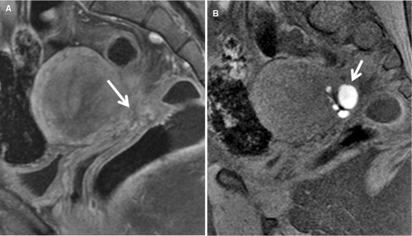 Deep pelvic endometriosis and fertility image