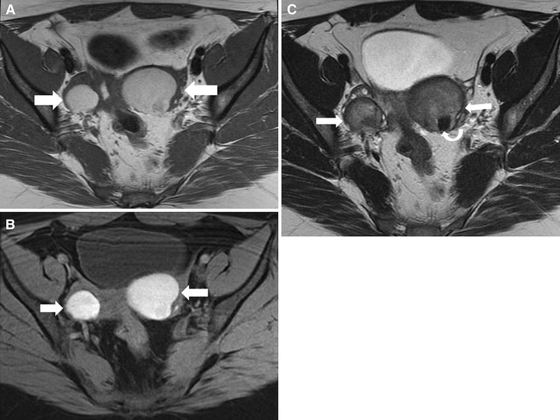 Radiological appearances of corpus luteum cysts and their imaging