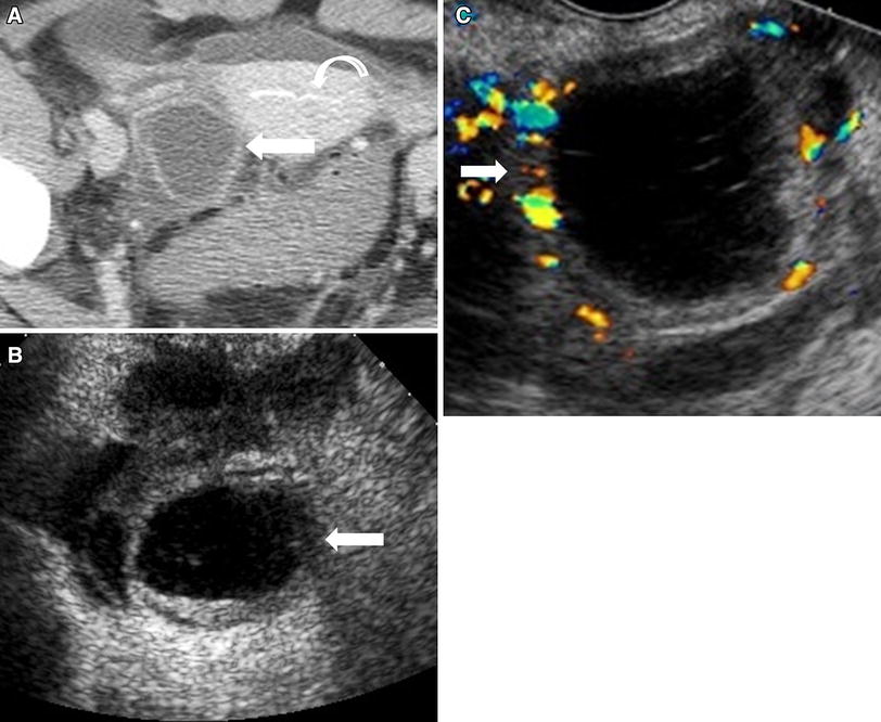 Radiological appearances of corpus luteum cysts and their imaging