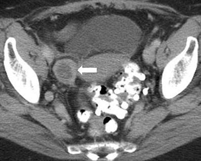 Radiological appearances of corpus luteum cysts and their imaging