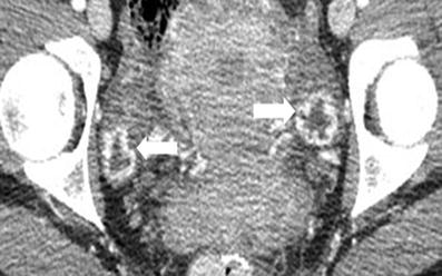 Radiological Appearances Of Corpus Luteum Cysts And Their Imaging 