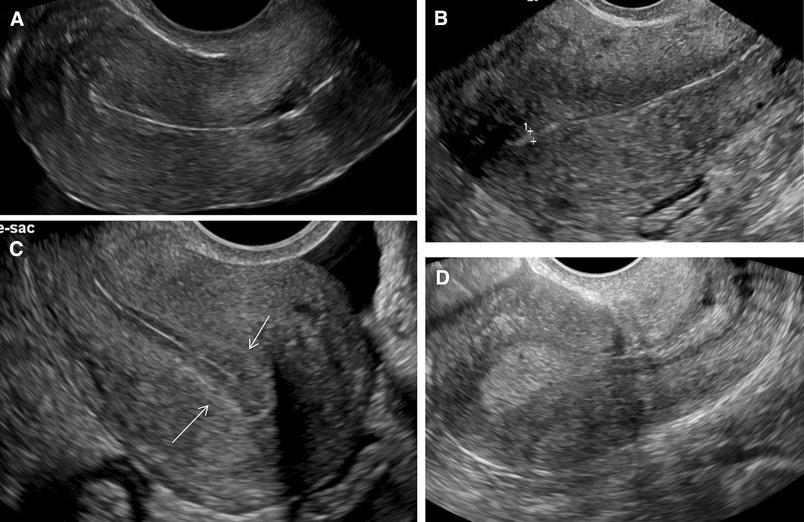 Through thick and thin a pictorial review of the endometrium Through thick and thin a pictorial review of the endometrium