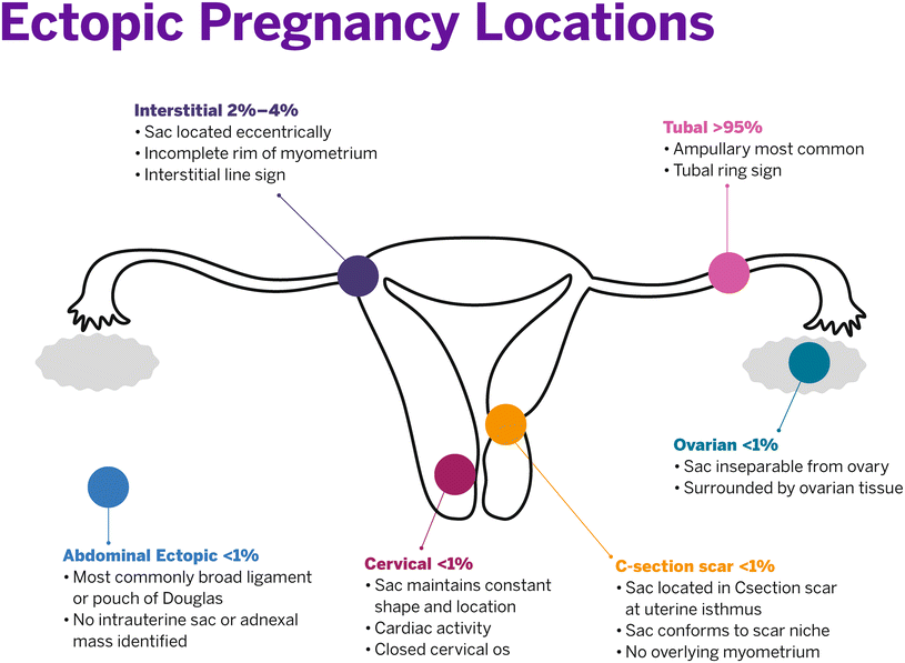 Pitfalls And Tips In The Diagnosis Of Ectopic Pregnancy SpringerLink
