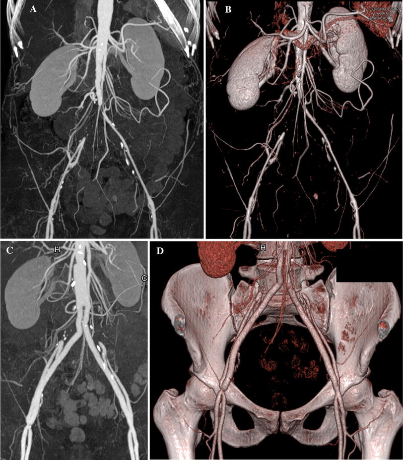 CT angiography and 3D imaging in aortoiliac occlusive disease ...