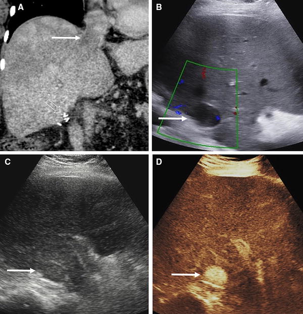 Contrast-enhanced ultrasound (CEUS) of the abdominal vasculature ...