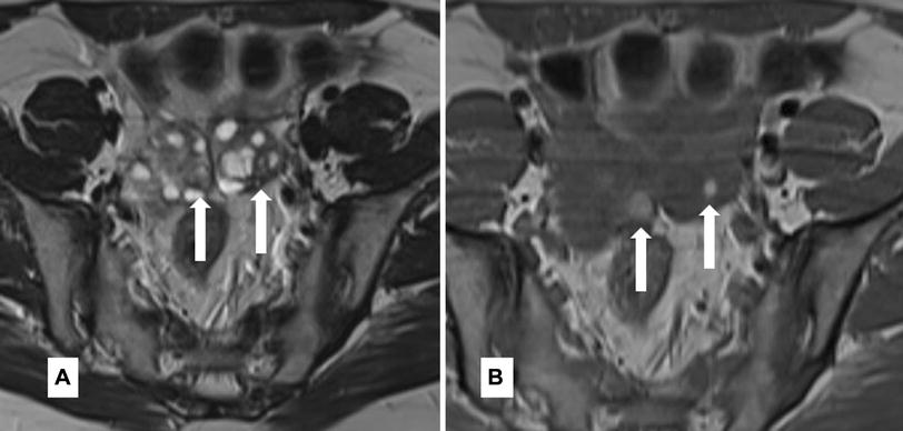 Kissing Ovaries Sign On Mri Springerlink