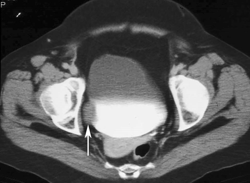 Decompressed Bladder On Ct Scan - ct scan machine