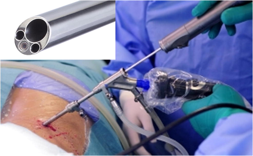 Endoscopic spine discectomy indications and SpringerLink