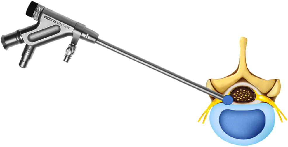 Endoscopic spine discectomy indications and SpringerLink