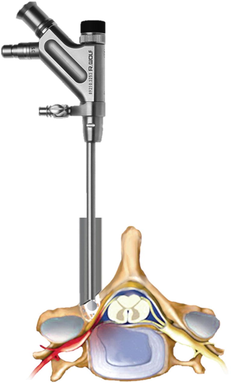 Endoscopic spine discectomy indications and SpringerLink