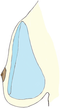 Back-to-Front Flipping of Implants Following Augmentation Mammoplasty