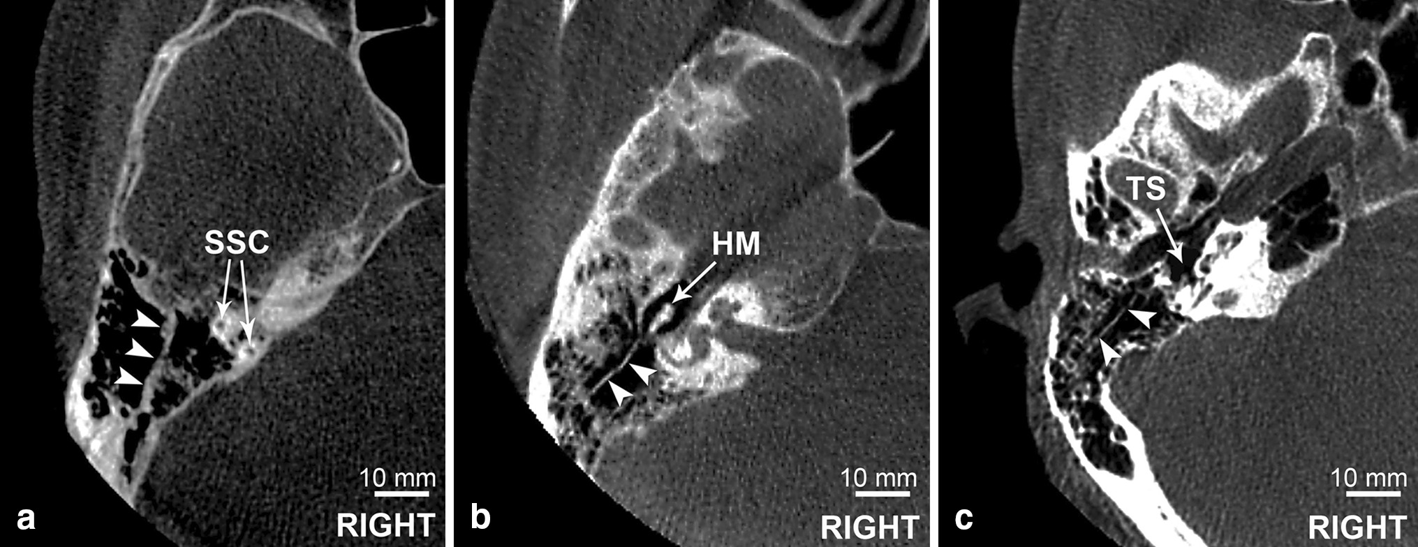 The radioanatomical assessment of the Körner’s septum SpringerLink