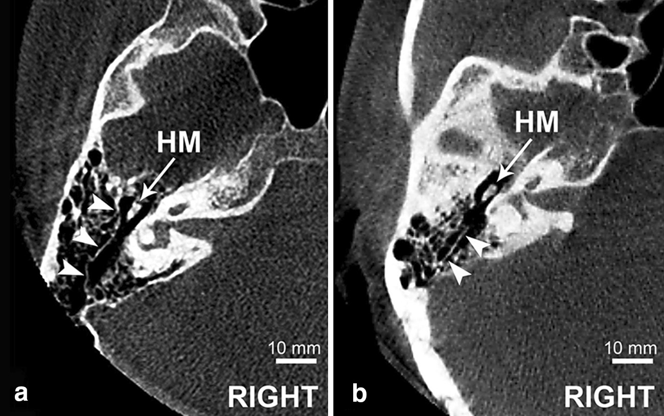 The radioanatomical assessment of the Körner’s septum SpringerLink