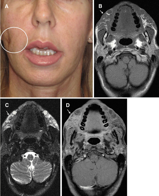 MRI in the evaluation of facial dermal fillers in normal and