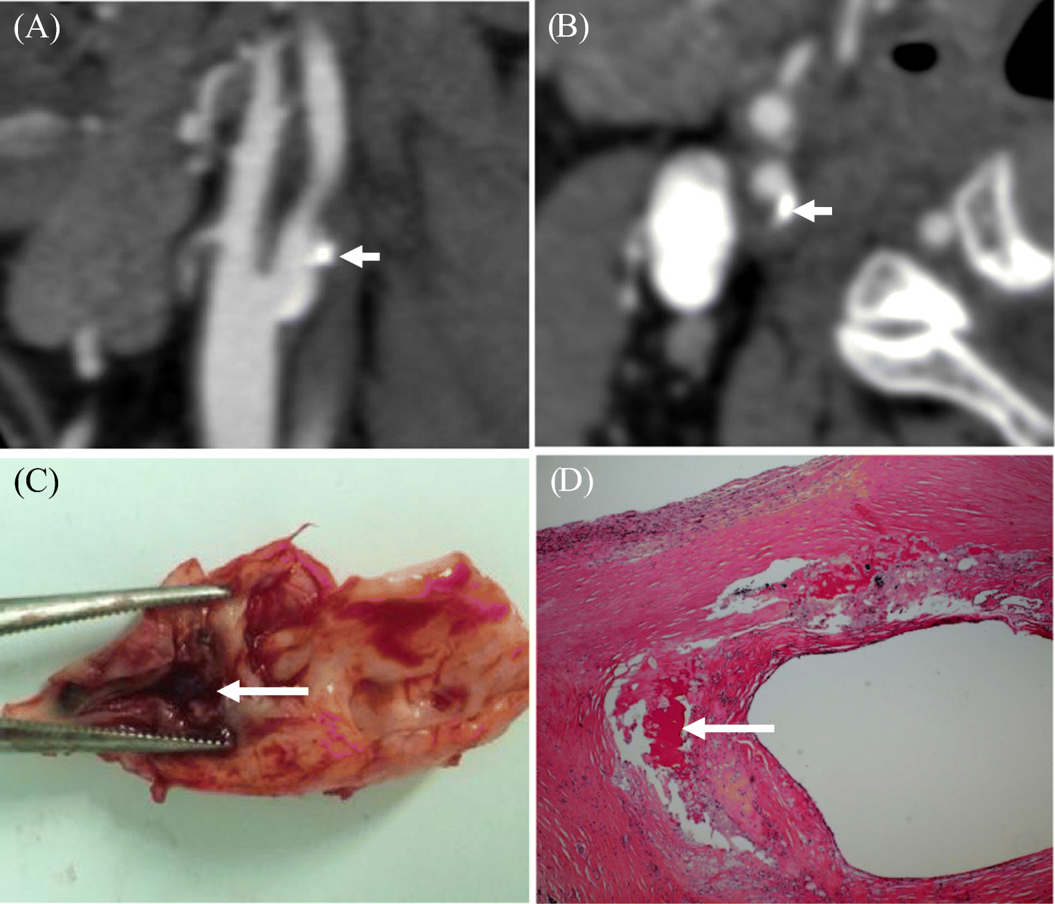 Superficial and multiple calcifications and ulceration associate with intraplaque hemorrhage in