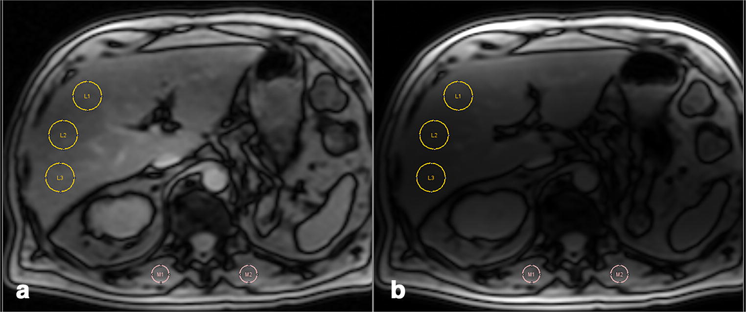 Practical guide to quantification of hepatic iron with MRI SpringerLink