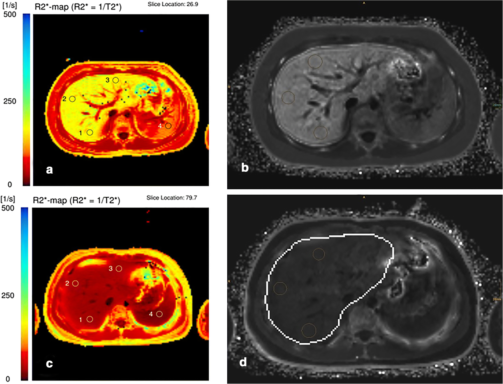 Practical guide to quantification of hepatic iron with MRI SpringerLink