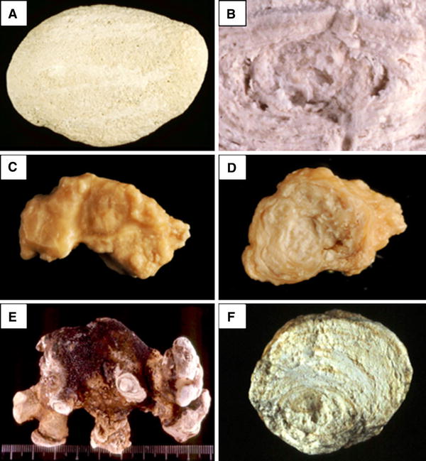 Kidney stone analysis “Give me your stone, I will tell you who you are