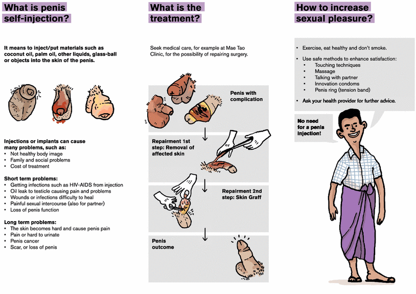 Complications of penile selfinjections investigation of 680 patients