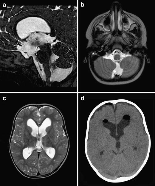 The clinical spectrum of Blake’s pouch cyst: report of six illustrative ...