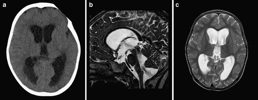 The clinical spectrum of Blake’s pouch cyst: report of six illustrative ...