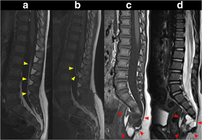 Spinal lipoma of the filum terminale: review of 174 consecutive ...