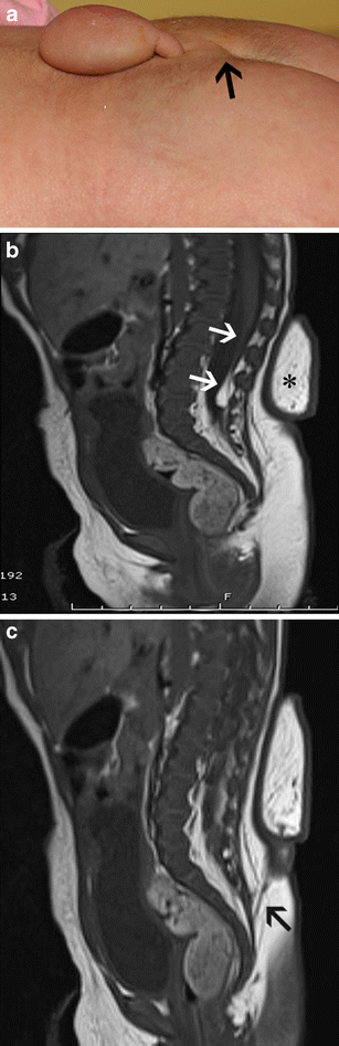 Proposed caudal appendage classification system; spinal cord tethering