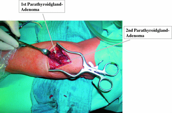 Recurrence of secondary hyperparathyroidism in patients ...