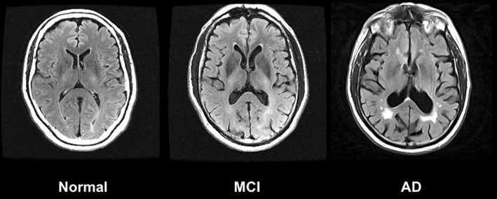 Magnetic resonance imaging in Alzheimer’s disease and mild cognitive ...