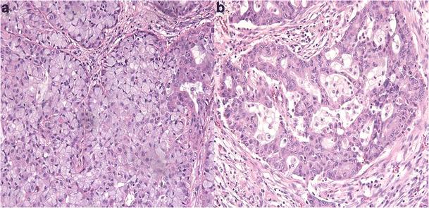 ROS1 gene rearrangement and copy number gain in non-small cell lung
