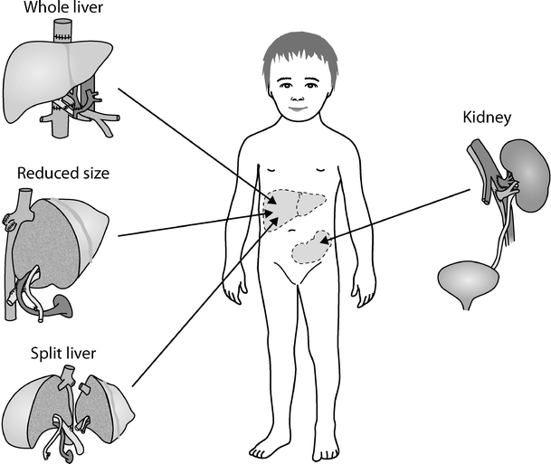 Combined liver and kidney transplantation in children SpringerLink
