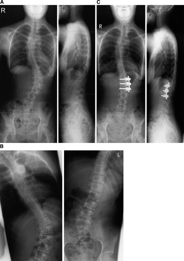 Short anterior correction of the thoracolumbar/lumbar curve in King 1
